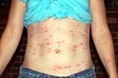 Как избавиться от чиггеров во дворе