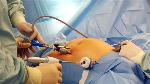 желудочное шунтирование