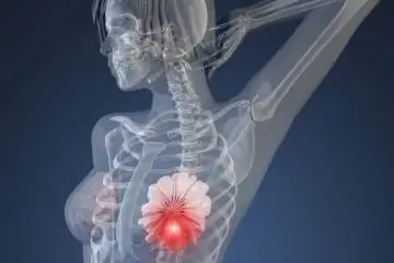 Как работают профилактические мастэктомии