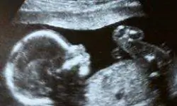 10 основных причин рождения детей с низким весом