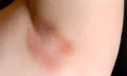 сыпь под мышками