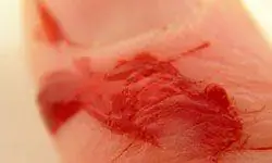 кровоточащий палец с порезом бумаги