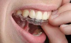 мальчик-подросток, носящий Invisalign