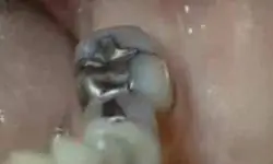Что такое амальгамы? Что такое амальгамы?