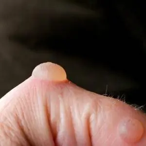 Безопасно ли прокалывать волдырь?