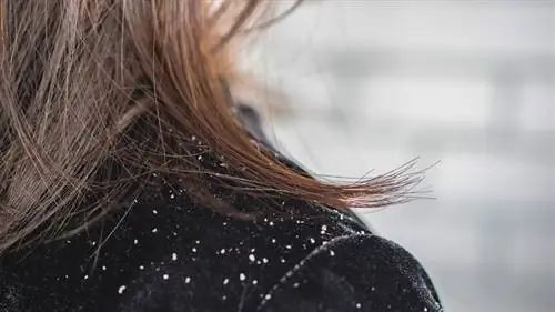 перхоть