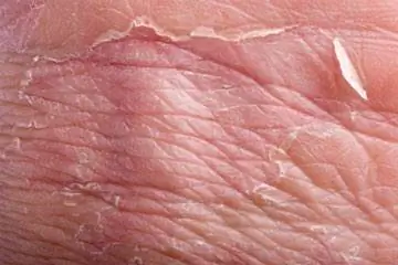 Синдром обожженной кожи