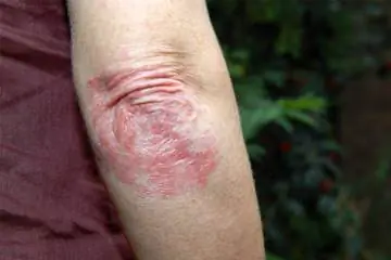 Розовый лишай Обзор