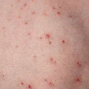 Фолликулит на спине у ребенка.