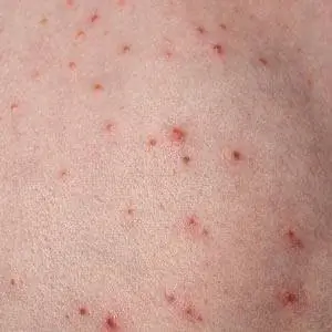 Обзор фолликулита