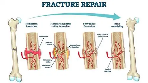 Ремонт переломов