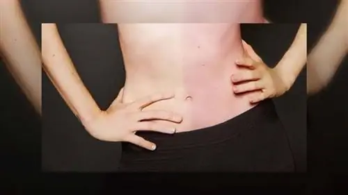 химеризм, близнец химеризм, близнец