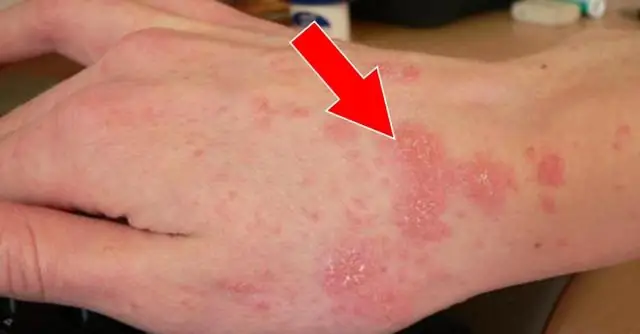 Как разводить Hoya krimson queen?