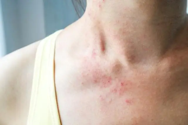 Что вызывает пятна на листьях розового куста?